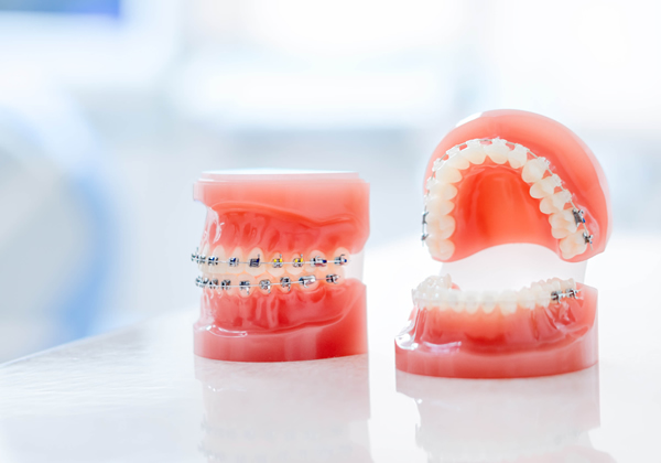 部分矯正のワイヤー矯正