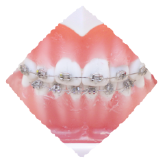 ブラケット矯正